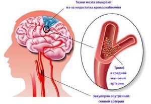 Церебральная энцефалопатия и атеросклероз thumbnail