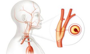 Атеросклероз сонных артерий стенозирующий thumbnail