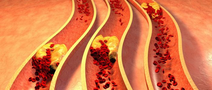 Атеросклероз артерий конечностей окклюзия пба thumbnail