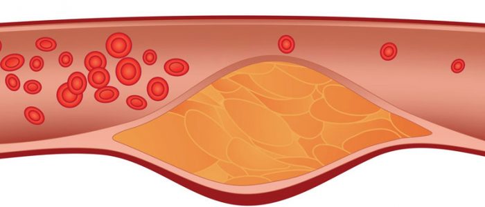 Причины атеросклероза при нормальном холестерине thumbnail