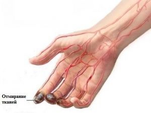 Окклюзия артерии при атеросклерозе thumbnail