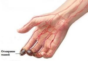 Атеросклероз периферических артерий конечностей thumbnail