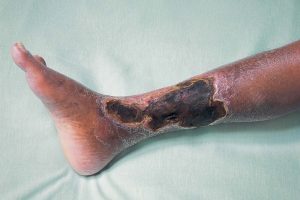 Ампутация ноги при облитерирующем атеросклерозе thumbnail