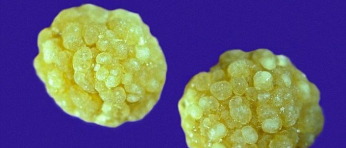 Холестериновые камни в желчном пузыре диагностика thumbnail