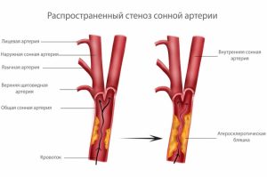 Как лечить атеросклероз внечерепных отделов брахиоцефальных артерий thumbnail