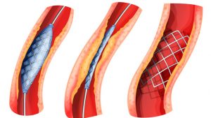 Нестенозирующий атеросклероз внечерепных брахиоцефальных артерий thumbnail