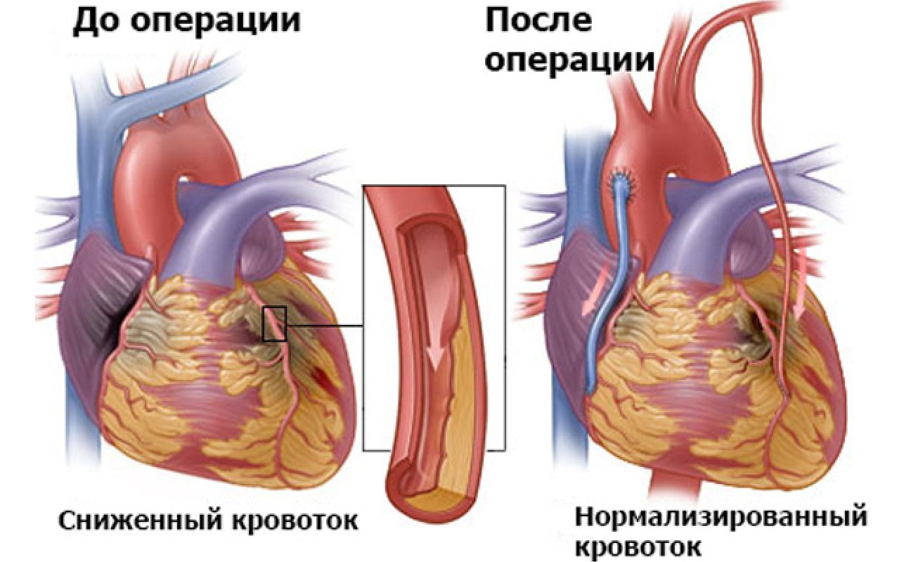 Что такое шунтирование сердца и сосудов. Инфаркт миокарда шунтирование. Операция шунтирование сердца инфаркт. Шунтирование сердца и стентирование при инфаркте миокарда. Аутовенозное аортокоронарное шунтирование.