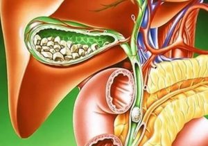 Чем лечить холестериновые бляшки в желчном пузыре thumbnail