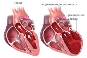 Сравнение сердец - норма и патология